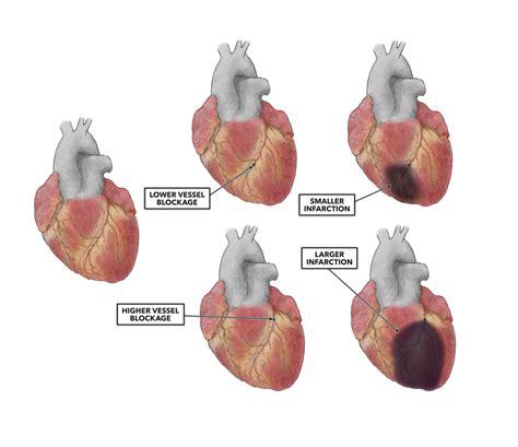 Crossfit The Heart Part 10 Myocardial Infarction