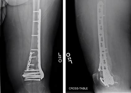 Distal Femur Fracture Orthopaedic Trauma Association OTA
