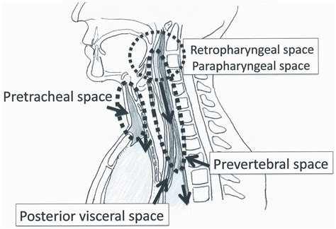 Deep Cervical And Paratracheal Drainage For Descending Necrotizing