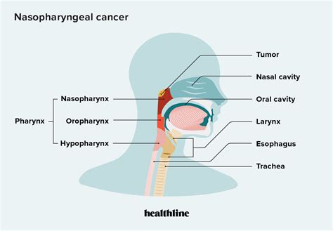 Nasopharyngeal Cancer Symptoms Stages Treatment