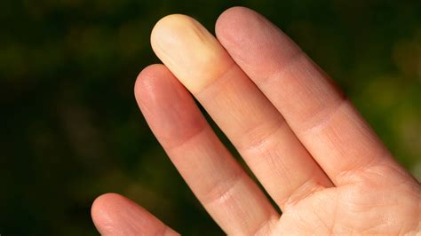 Thrombophlebitis In Fingers