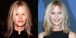 Meg Ryan S Plastic Surgery Face Before And After Photos