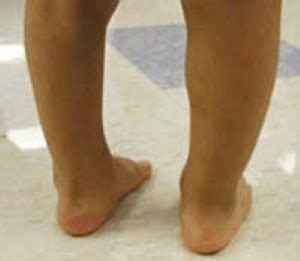 Club foot may affect one or both feet. Clubfoot - OrthoInfo - AAOS