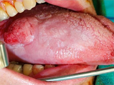 Hpv Tongue Base Cancer Tratament Usturoi Paraziti Hpv Tongue Base Cancer
