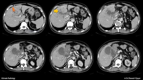 Ultimate Radiology Acute Cholecystitis With Intrahepatic Perforation