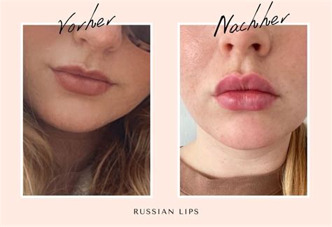 Russian Lips Alles Zur Lippenunterspritzung And Erfahrungen