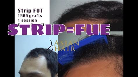 Hair Transplant In The Philippines Manila And Asia Youtube