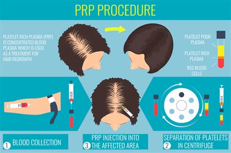 Platelet Rich Plasma Therapy for Hair - Beauty Lounge in San Marcos, CA