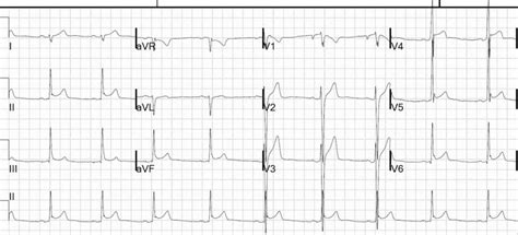 Filtering on an ecg is done four fold: Benign Early Repolarisation • LITFL • ECG Library Diagnosis