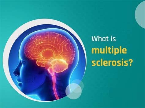 Guide To Multiple Sclerosis Symptoms Causes And Treatments Eves Weekly