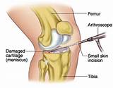 Bilateral Partial Knee Replacement Recovery Time Images