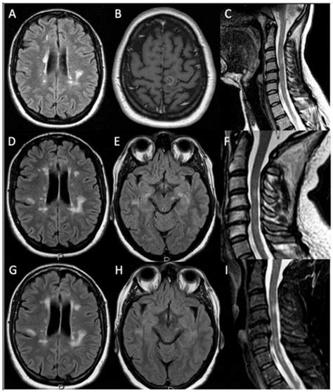 Patients Brain And Spinal Cord Mris 15 Tesla Brain And Spinal Cord