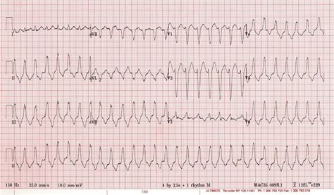 Search for an ekg strip from a simple drop down list. VT versus SVT | Medical textbooks, Ventricular tachycardia ...