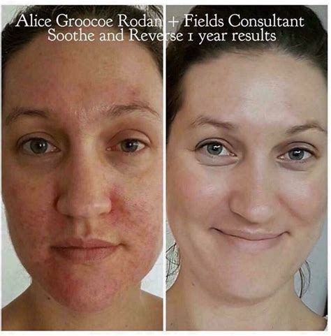 Relief For Sensitive Skin Soothe Rodan Fields Premium Skincare