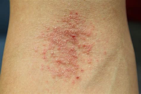 Eczema Type Iv Hypersensitivity Rash On Hands Types Of Skin Rashes