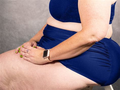 Lipedema The Four Stages And Types