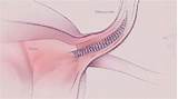 Pictures of What Are The Side Effects Of The Essure