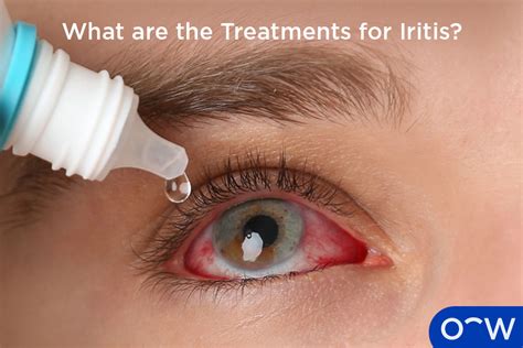 Iritis Types Causes Symptoms Diagnosis And Treatment