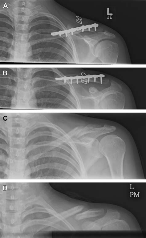 Clavicle Shaft Fractures In Adolescents Orthopedic Clinics