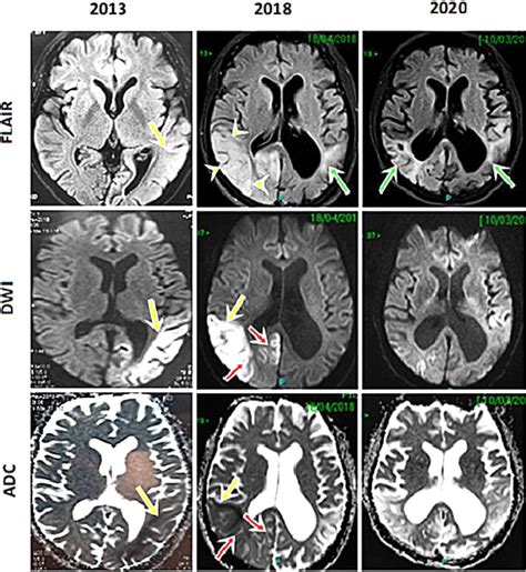 Brain Mri Findings Fluid Attenuated Inversion Recovery Flair