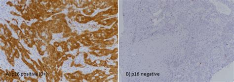 Cureus P16 Immunohistochemical Expression In Head And Neck Squamous