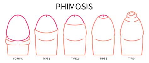 Tight Foreskin Phimosis Causes Symptoms And Treatment