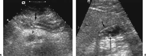 Ultrasound Of The Gastrointestinal Tract Radiology Key