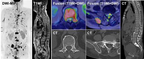 Whole‐body Diffusion‐weighted Magnetic Resonance Imaging Diagnosis And