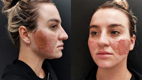 Acne Scar Removal With Co2 Laser Treatment Before And After Youtube