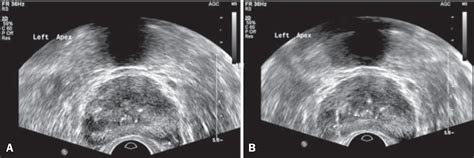 Scielo Brasil The Role Of Transrectal Ultrasound In The Diagnosis