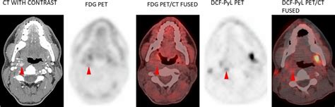 Patient 1 Molecular Imaging Shows Increased Radiotracer Uptake In The