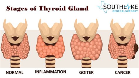 Thyroid Issues Thyroid Cancer Thyroid Gland Thyroid Disease Thyroid