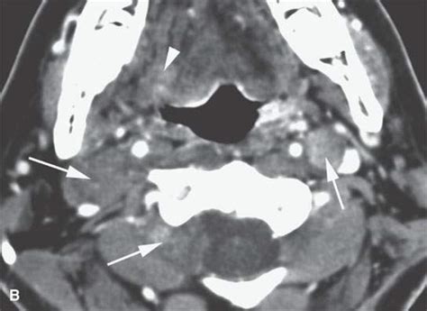 Benign And Malignant Peripheral Nerve Sheath Tumors Radiology Key