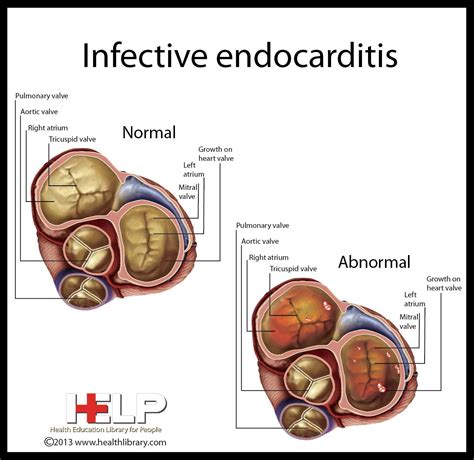 Infective Endocarditis The Life Of A Nursing Student Pinterest