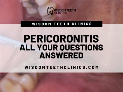 Pericoronitis All Your Questions Answered — Wisdom Teeth Clinics