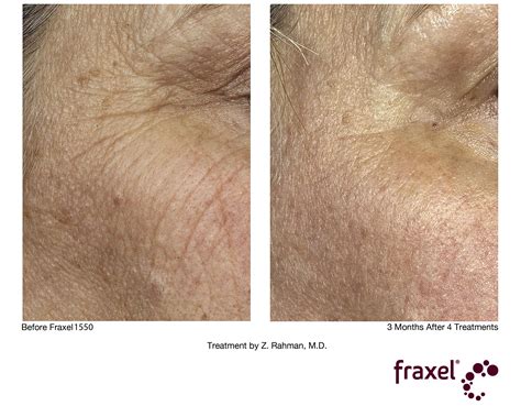 Fraxel Laser Skin Resurfacing Treatment Studiomd Long Island