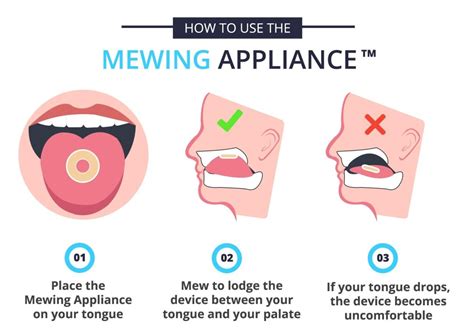 Mewing Appliance A Device To Improve Your Facial Appearance