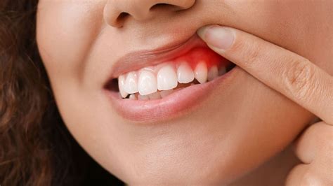 How To Treat Periodontal Disease Hinsdale Dental