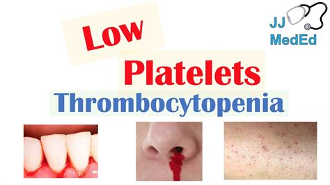 Thrombocytopenia Signs And Symptoms And Approach To Causes Youtube