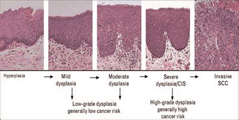 The Progression Of Oral Squamous Cell Carcinoma From Epithelial