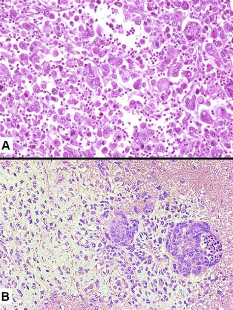 Histology Of Giant Cell Carcinoma Showing A Discohesive Proliferation
