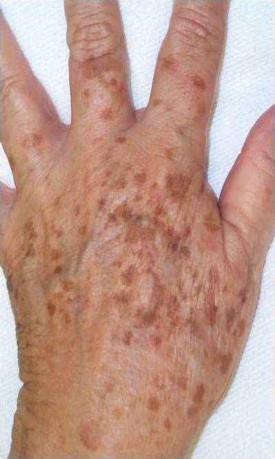 Brown Age Spots On Hands See This Age Spot Information And How People