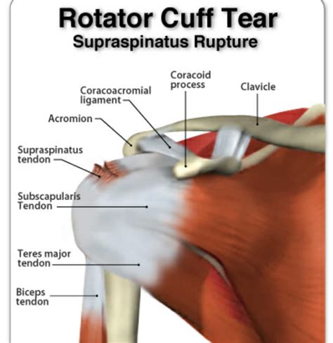 When you raise your arm to shoulder height, the space between the acromion and rotator cuff narrows. Diagram Of Rotator Cuff Torn Rotator Cuff, Surgery Needed ...