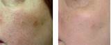 Skin Discoloration After Laser Treatment