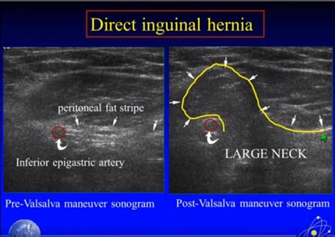 The Direct Hernia Projects Through The Inguinal Triangle The Indirect