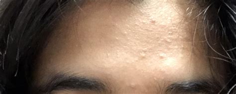 Skin Concerns These Tiny Bumps Are All Over My Cheeks And Jawline And