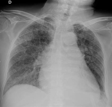 Chest X Ray On 7th Day Bilateral Interstitial Infiltrates Download