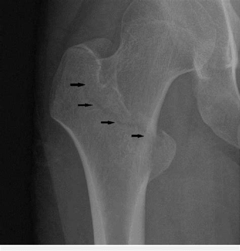 Radiograph Showing An Intertrochanteric Nondisplaced Fracture Arrows