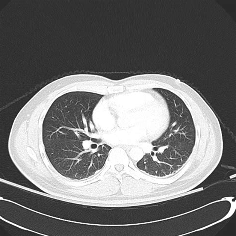Normal Lung Ct
