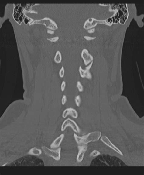 Normal Cervical Spine Mri Including Dixon Image